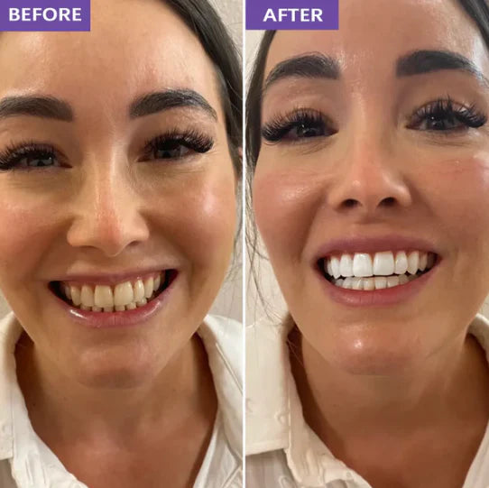 Novora Purple Teeth Whitening Strips